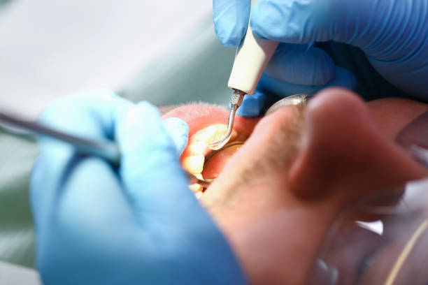 Best Emergency Tooth Extraction in Country Clu, MO
